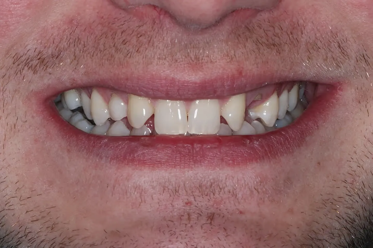 1_Before