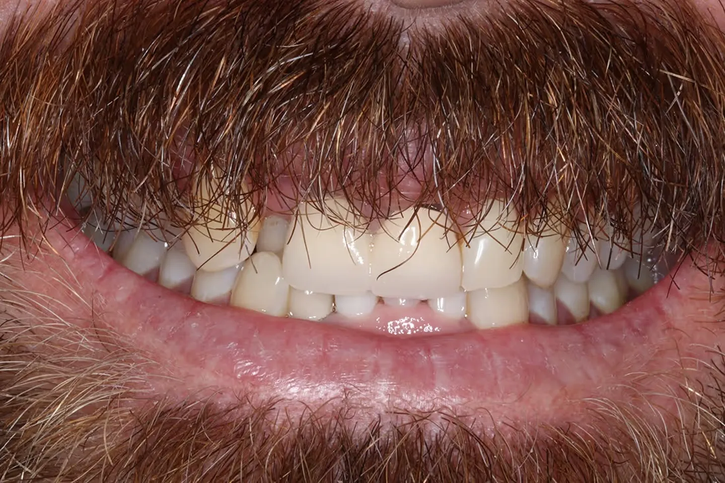 2_Before